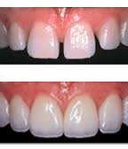 دندانهای فاصله دار چطور درمان میشوند؟