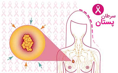 مرگ سالانه ۳ هزار زن ایرانی بر اثر سرطان سینه
